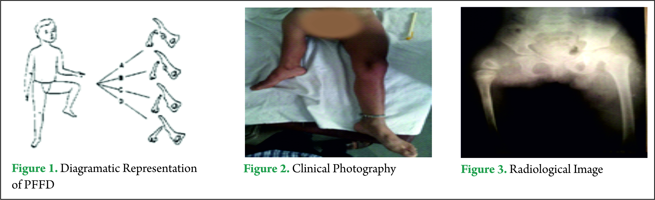 Proximal Femoral Focal Deficiency A Case Report | International Journal ...